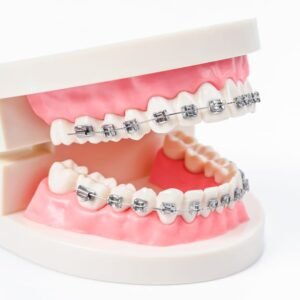 Study Model with Braces